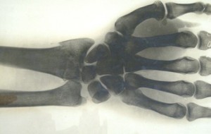 wrist fracture X-ray; Hickman archive MHS